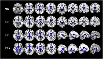 Diffusion and functional MRI reveal microstructural and network connectivity impairment in adult-onset neuronal intranuclear inclusion disease